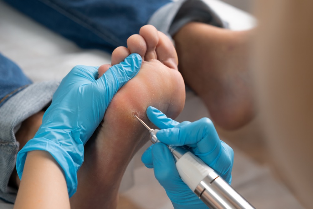 Podiatrist treating patient's foot sole with medical drill