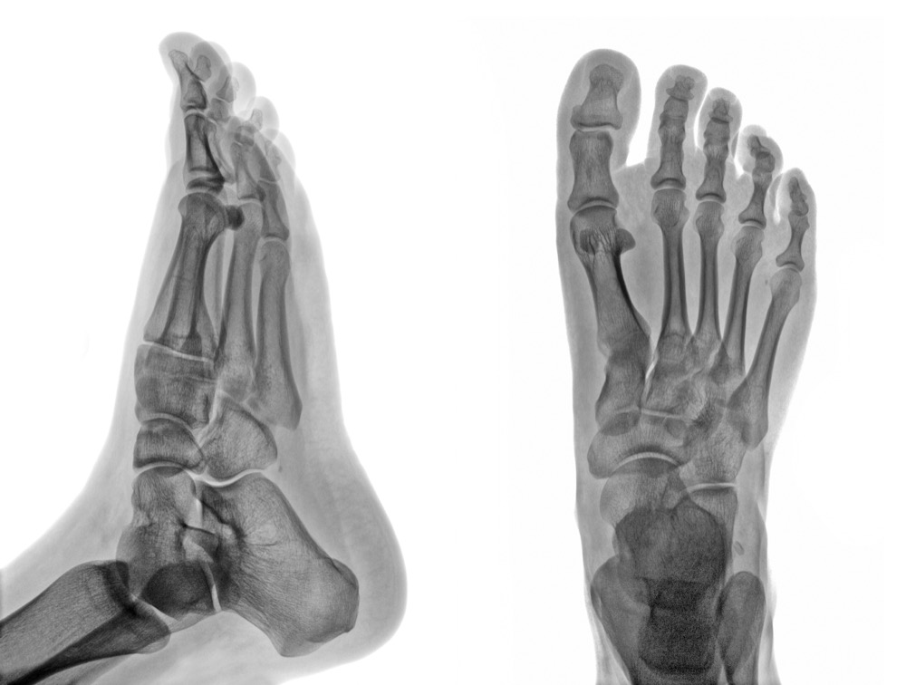 X-ray images of human foot from two angles