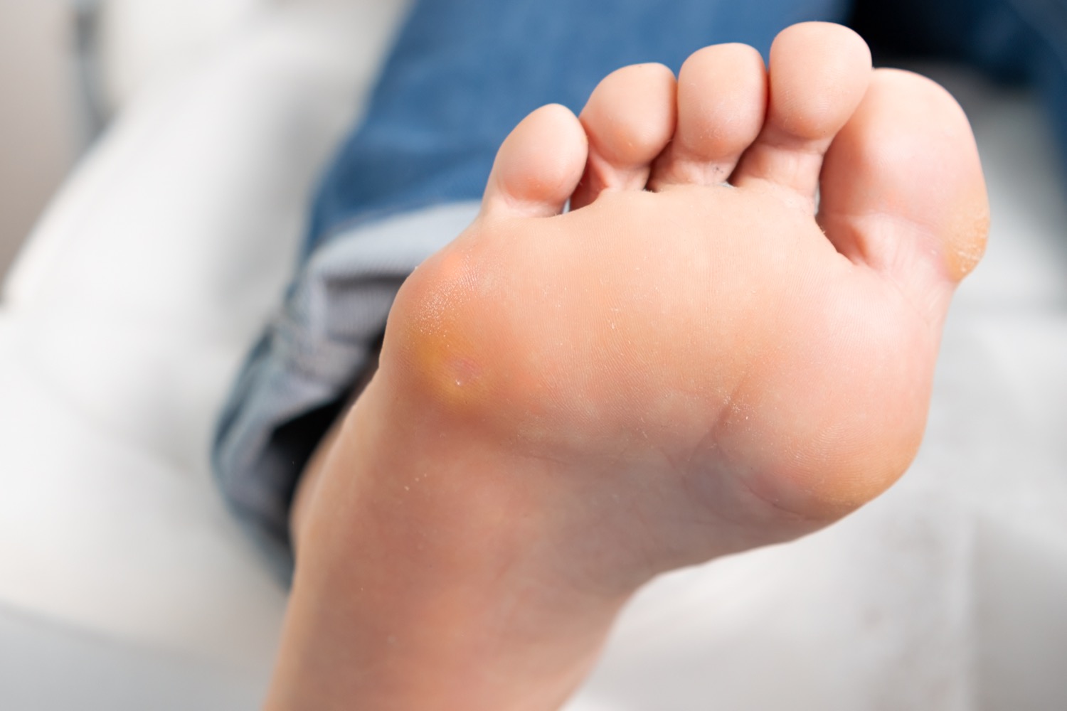 Close-up of bare human foot sole with visible callus