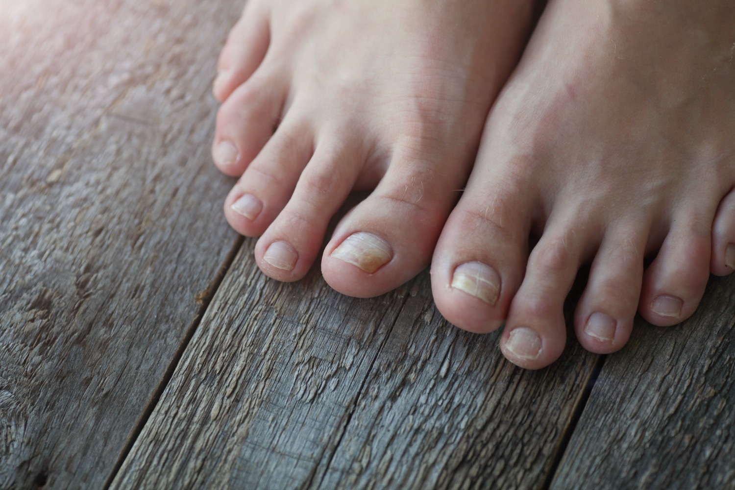 Bare feet with toenail fungus on wooden surface