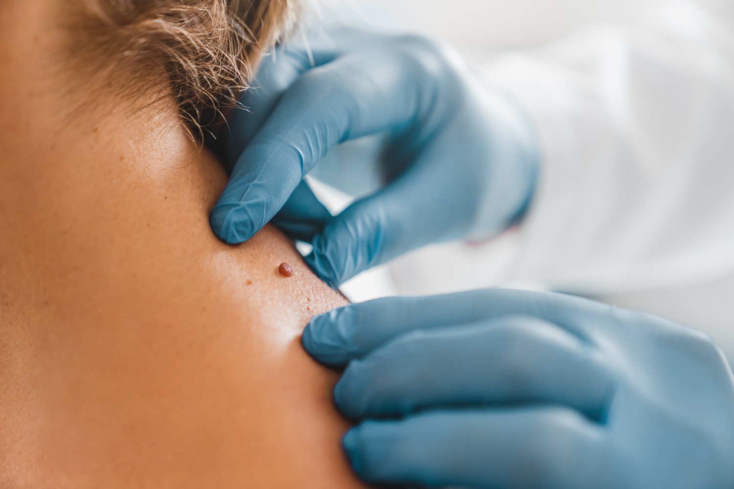 Doctor examining mole on patient's neck with gloved hands