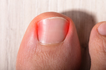 Close-up of inflamed ingrown toenail on big toe