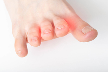 Close-up of foot toes with red inflammation between them