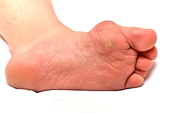 Close-up of human foot sole showing a plantar wart