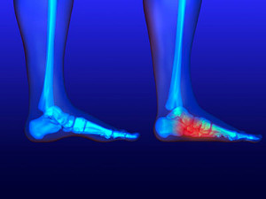 X-ray of feet showing highlighted ankle joint inflammation