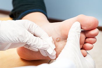 Doctor examining plantar wart on patient's foot sole