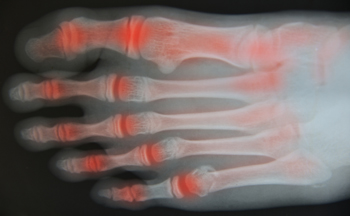 X-ray of foot showing red inflammation in joints
