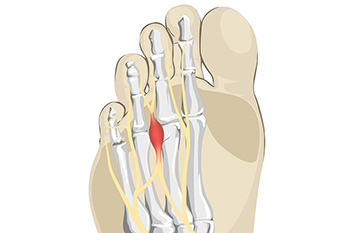 Medical illustration of foot bones highlighting Morton's neuroma location