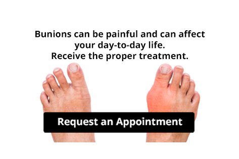 Feet with bunion condition highlighting painful joint deformity