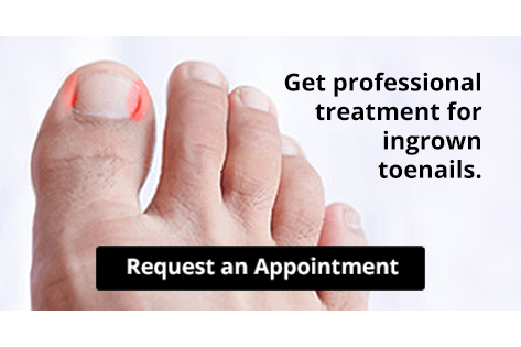Close-up of foot with painful ingrown toenail highlighted in red
