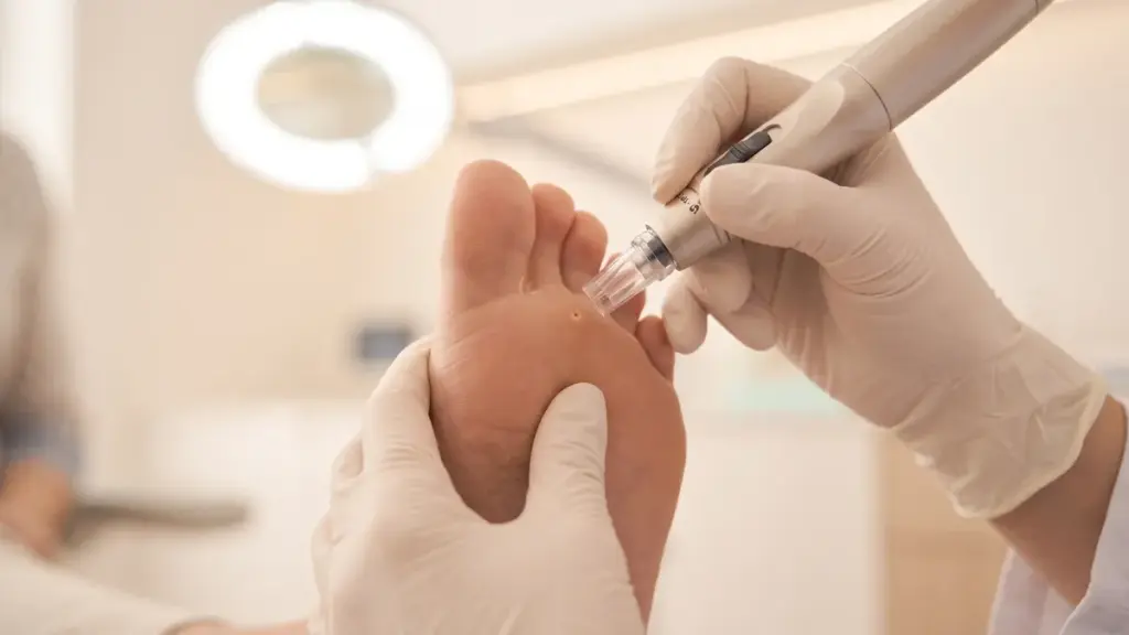 Podiatrist performing CO2 laser treatment for a plantar wart at Foot Center of the RGV in McAllen