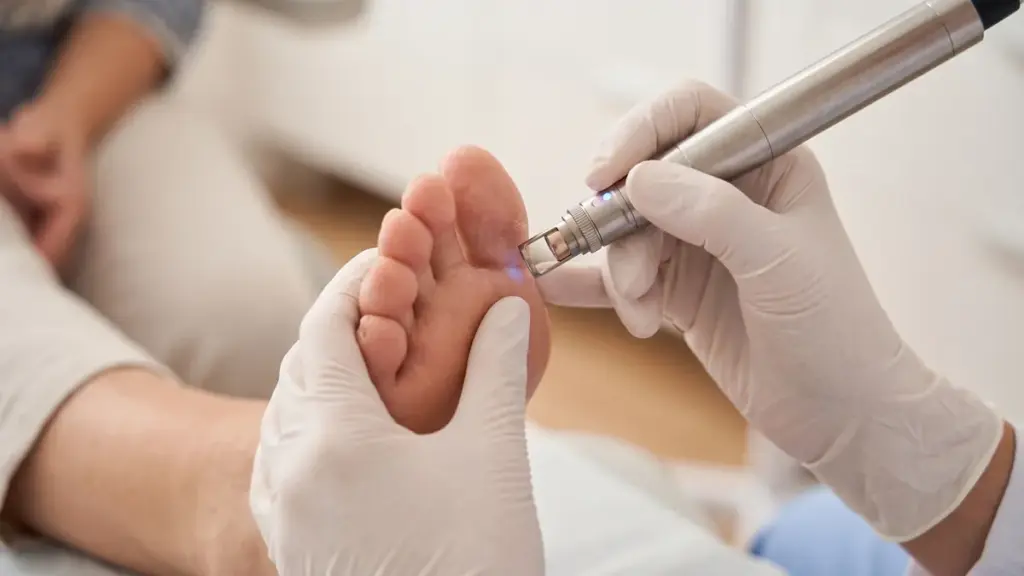 Podiatrist administering CO2 laser treatment for toenail fungus at Foot Center of the RGV in McAllen